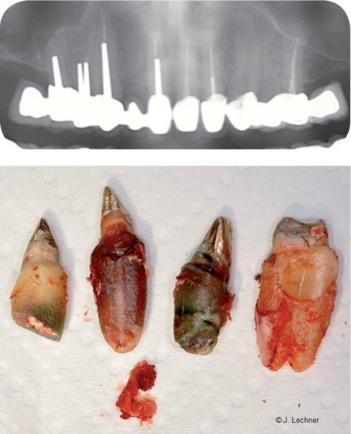 Wurzelbehandelte Zähne auf dem Röntgenbild und in Natura. Totes Gewebe hinterlässt seine Spuren.